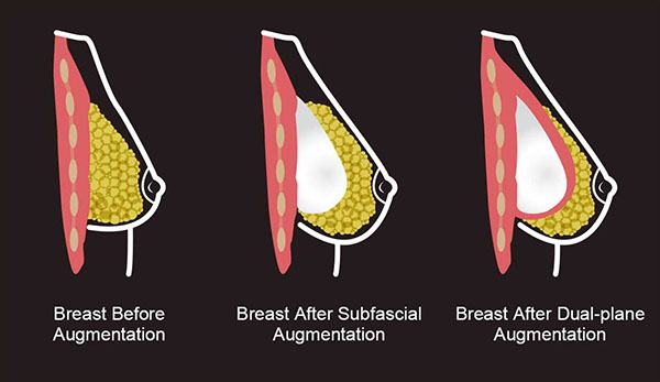 sub-fascial breast augmentation diagram