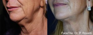 EmbraceRF before & after