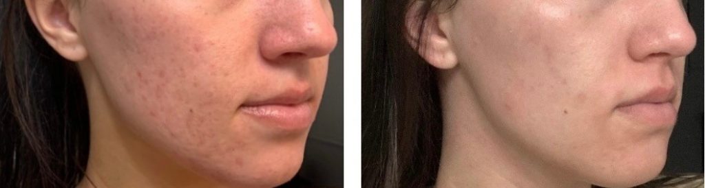 Tetra CO2 before/after