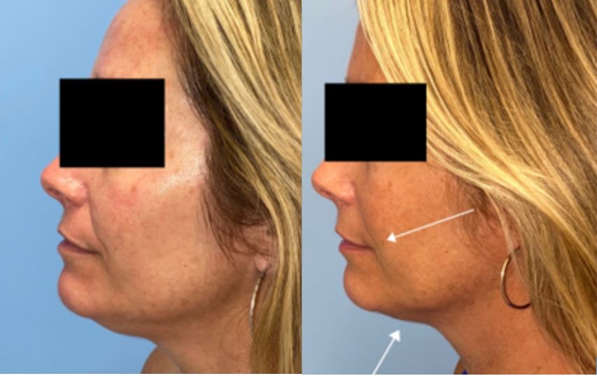 Sofwave Facial Skin Tightening Before and After with arrows pointing to jowls and neck where skin is tightened