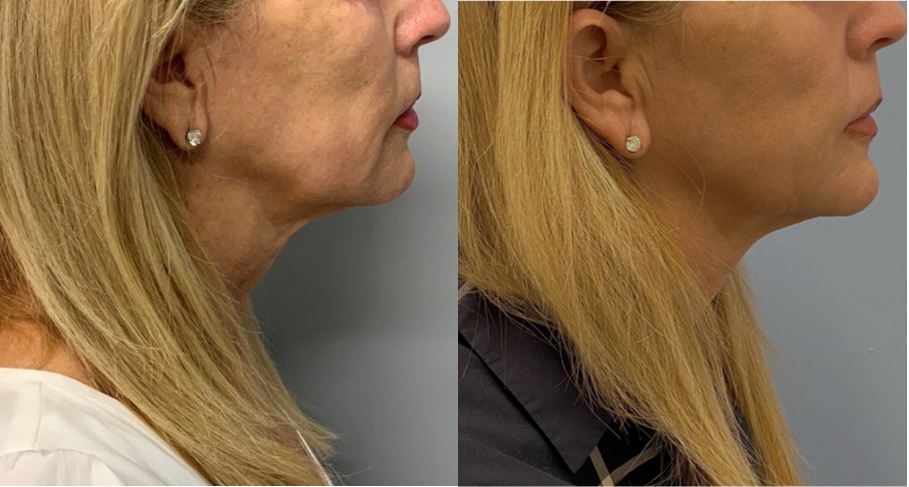 Sofwave skin tightening of neck and jawline before and after