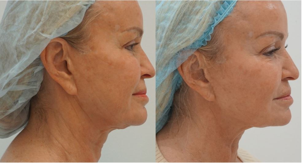 Sofwave skin tightening before and after of jowls, neck and chin