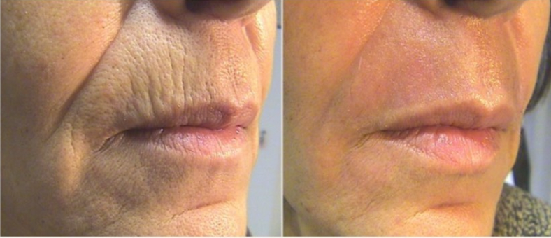 Tetra CO2 laser before and after - wrinkles around mouth