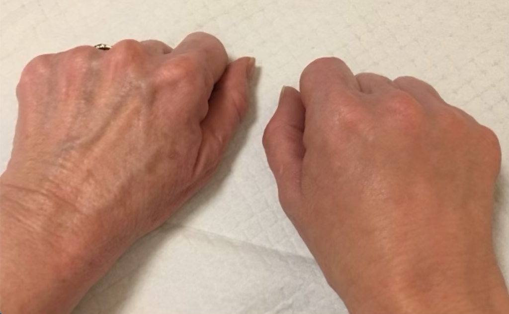Hand rejuvenation before and after