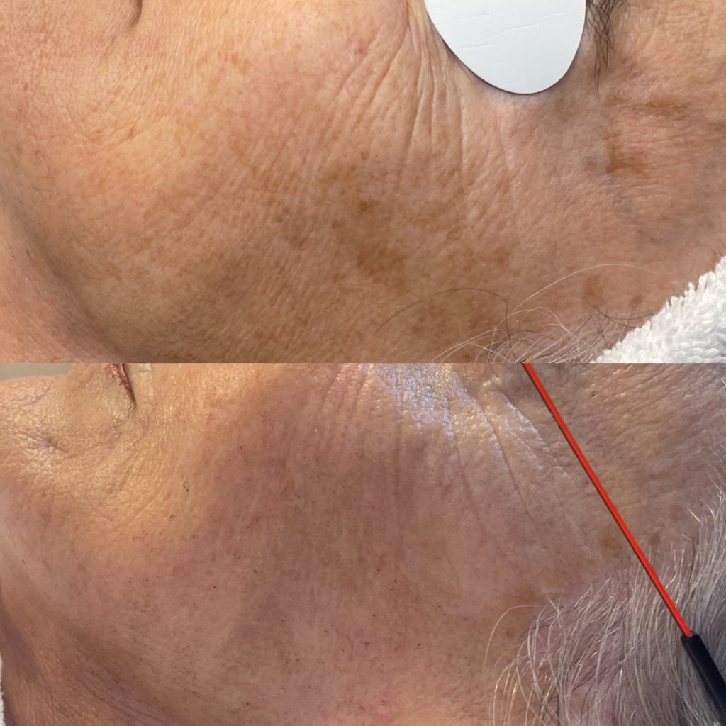 BBL HERO laser treatment for melasma before and after