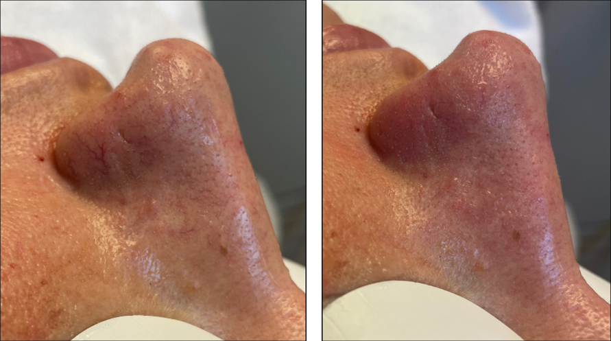 BBL HERO laser treatment for veins before and after