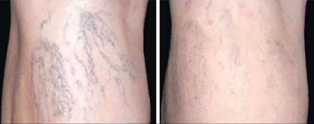 ClearV for veins before and after