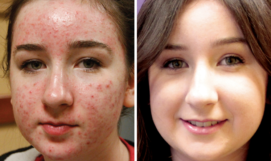 Forever Clear BBL for active acne before and after