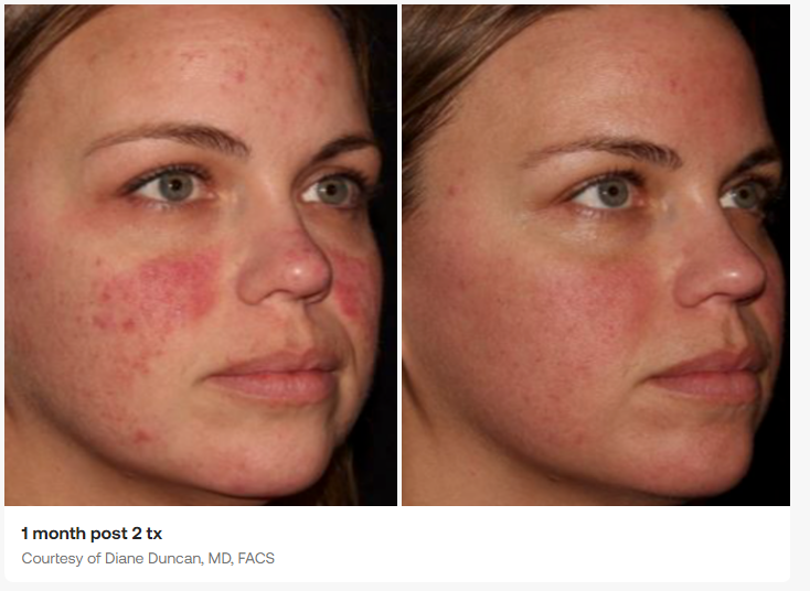 HALO laser treatment for redness before and after