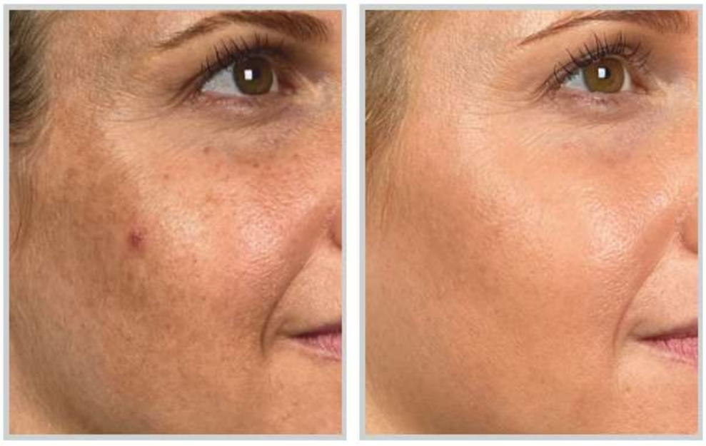 HALO laser treatment for melasma before and after