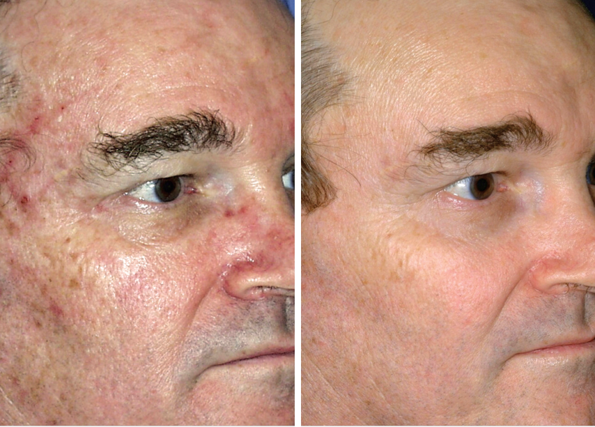 MicroLaserPeel treatment for redness before and after