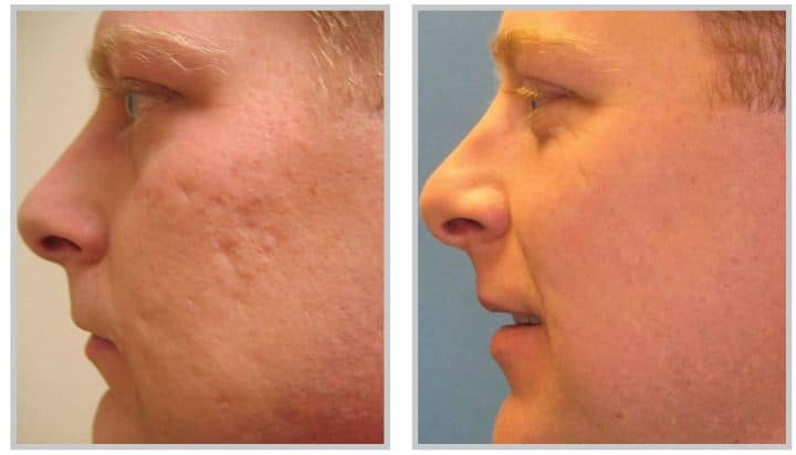 MicroLaserPeel + Profractional laser treatment for acne scarring before and after