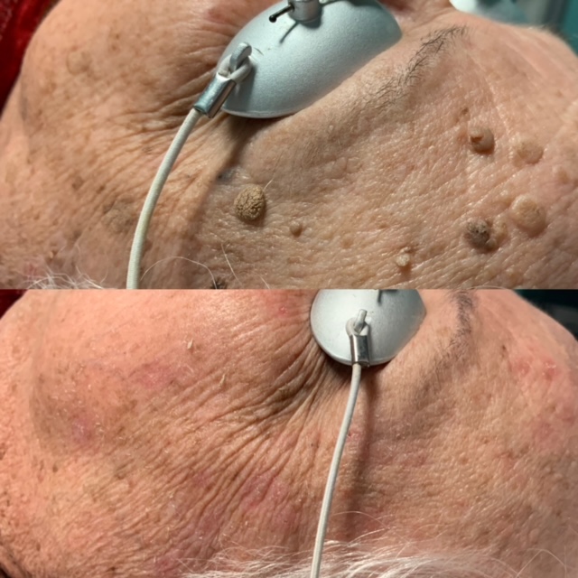 Mole and skin tag removal with laser skin resurfacing before and after
