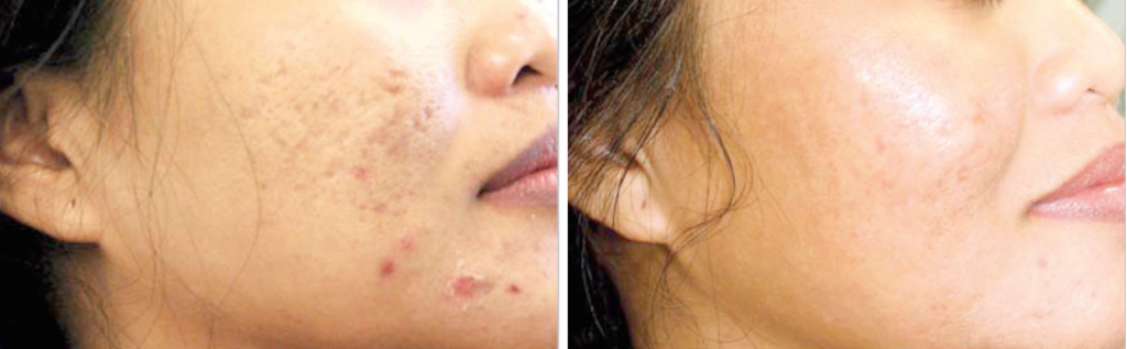 Profractional laser for acne and acne scarring before and after