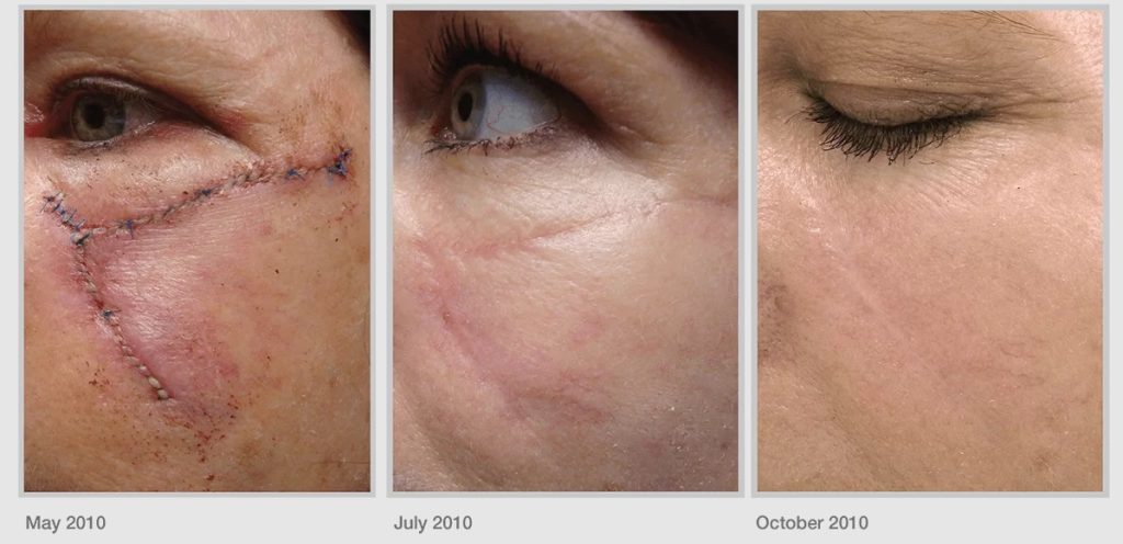 Profractional laser for scars before and after 2 months and after 5 months