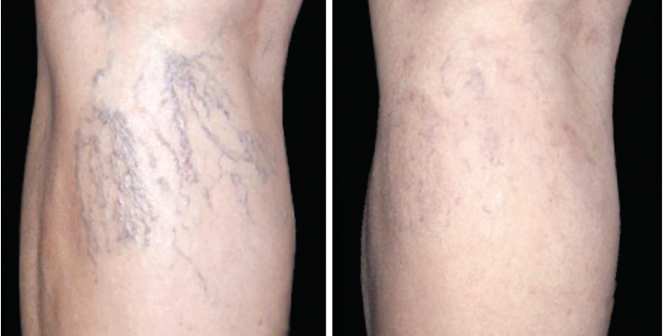 ClearV vein removal before and after 