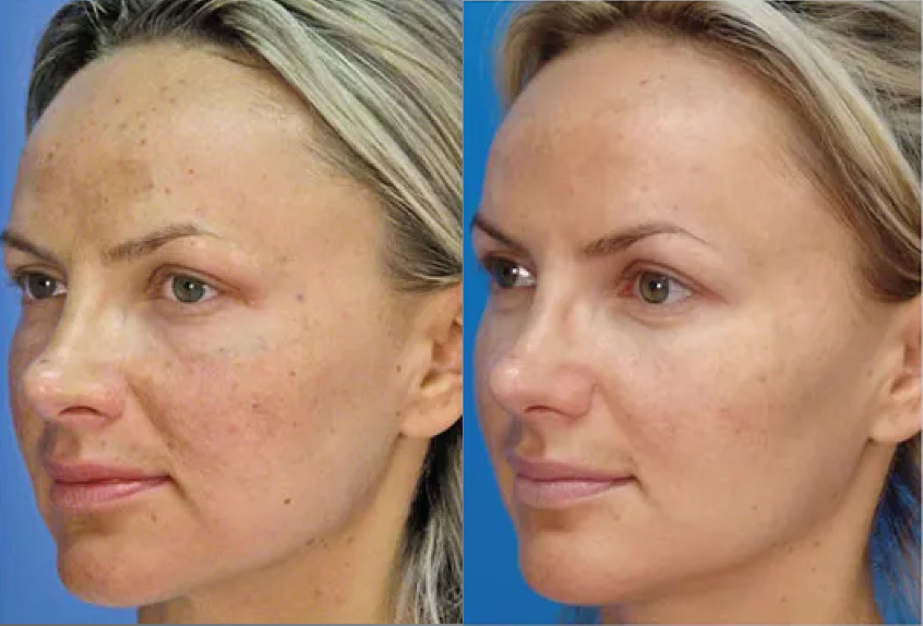 Artic Peel before and after