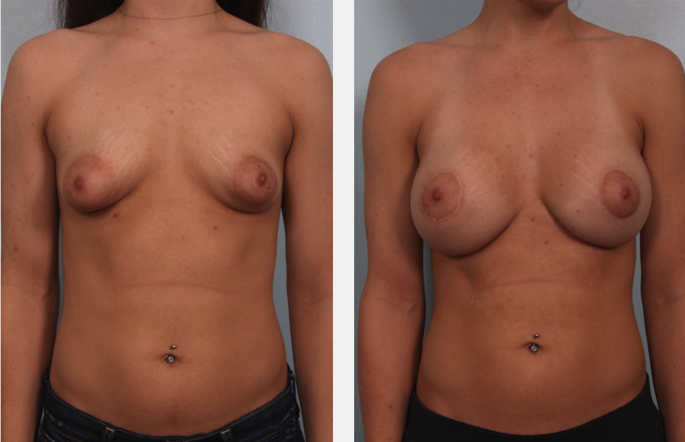 Real patient tuberous breast surgery results