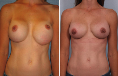 Real patient before and after Revision Breast Surgery