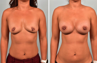 Real patient nipple/areolar surgery results