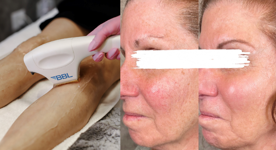 BBL laser skin resurfacing treatment and before and after photos