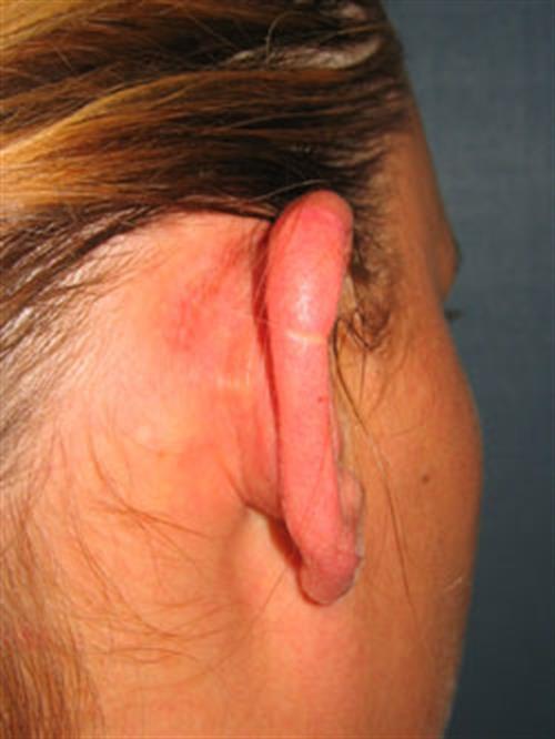 Facial & Body Reconstruction After Photo | Phoenix and Scottsdale, AZ | Scottsdale Center for Plastic Surgery