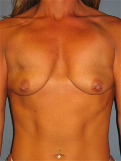 Breast Lift (Mastopexy) Before Photo | Phoenix and Scottsdale, AZ | Scottsdale Center for Plastic Surgery