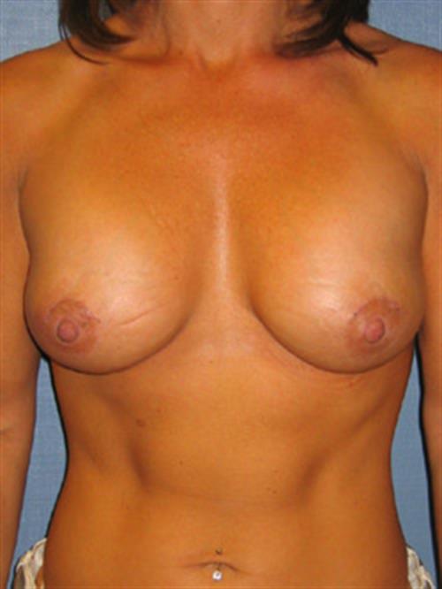 Breast Lift (Mastopexy) After Photo | Phoenix and Scottsdale, AZ | Scottsdale Center for Plastic Surgery