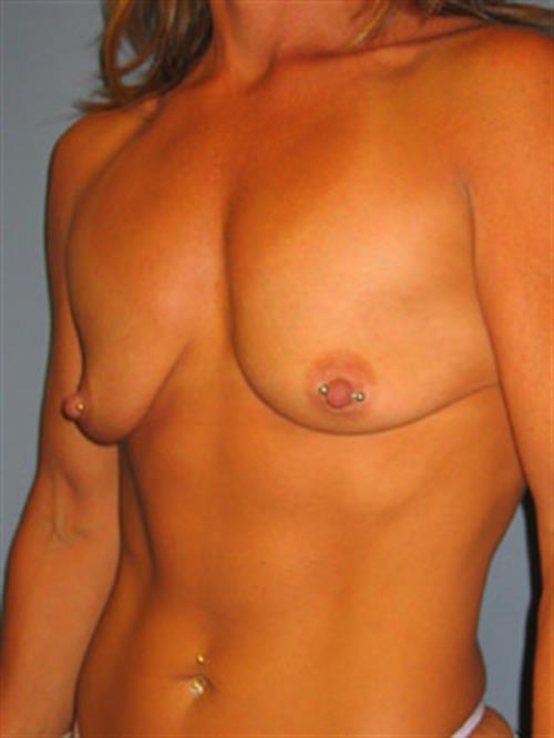 Breast Lift (Mastopexy) Before Photo | Phoenix and Scottsdale, AZ | Scottsdale Center for Plastic Surgery