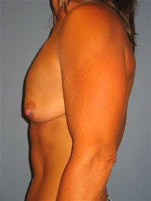 Breast Lift (Mastopexy) Before Photo | Phoenix and Scottsdale, AZ | Scottsdale Center for Plastic Surgery