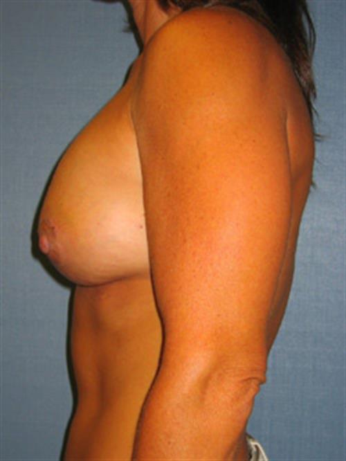 Breast Lift (Mastopexy) After Photo | Phoenix and Scottsdale, AZ | Scottsdale Center for Plastic Surgery