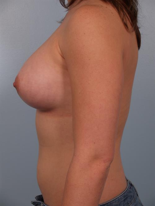 Breast Augmentation After Photo | Phoenix and Scottsdale, AZ | Scottsdale Center for Plastic Surgery