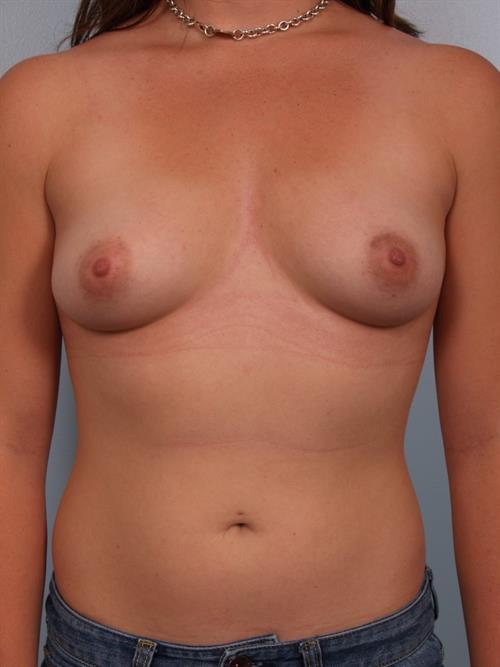 Breast Augmentation Before Photo | Phoenix and Scottsdale, AZ | Scottsdale Center for Plastic Surgery