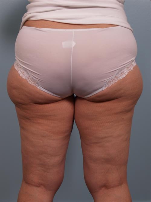 Power Assisted Liposuction Before Photo | Phoenix and Scottsdale, AZ | Scottsdale Center for Plastic Surgery