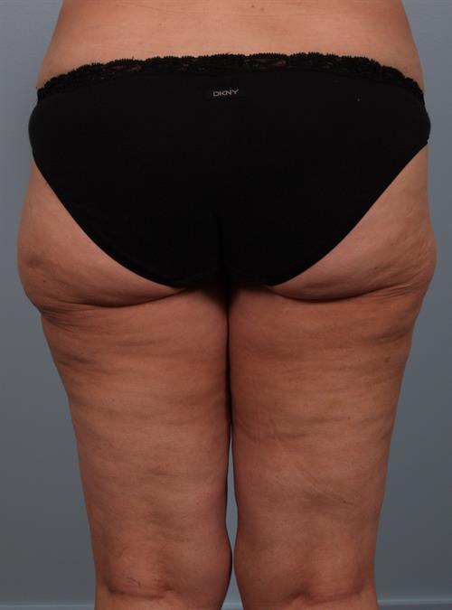 Power Assisted Liposuction After Photo | Phoenix and Scottsdale, AZ | Scottsdale Center for Plastic Surgery