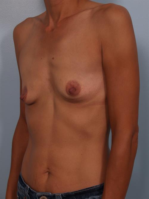 Breast Augmentation Before Photo | Phoenix and Scottsdale, AZ | Scottsdale Center for Plastic Surgery