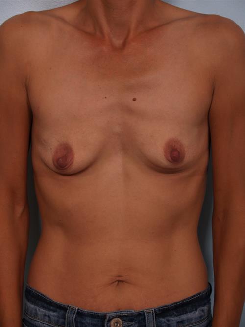 Breast Augmentation Before Photo | Phoenix and Scottsdale, AZ | Scottsdale Center for Plastic Surgery