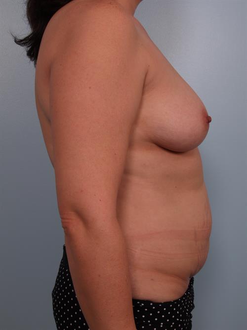 Mommy Makeover Before Photo | Phoenix and Scottsdale, AZ | Scottsdale Center for Plastic Surgery