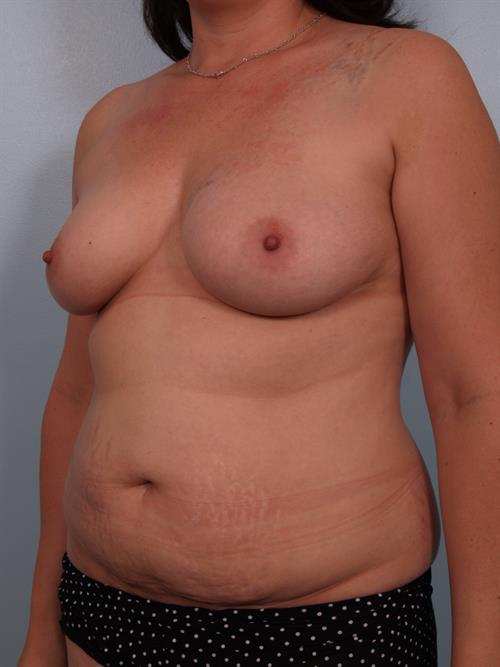 Mommy Makeover Before Photo | Phoenix and Scottsdale, AZ | Scottsdale Center for Plastic Surgery