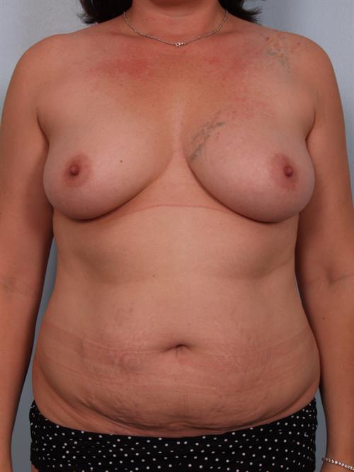 Mommy Makeover Before Photo | Phoenix and Scottsdale, AZ | Scottsdale Center for Plastic Surgery