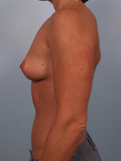 Breast Augmentation Before Photo | Phoenix and Scottsdale, AZ | Scottsdale Center for Plastic Surgery