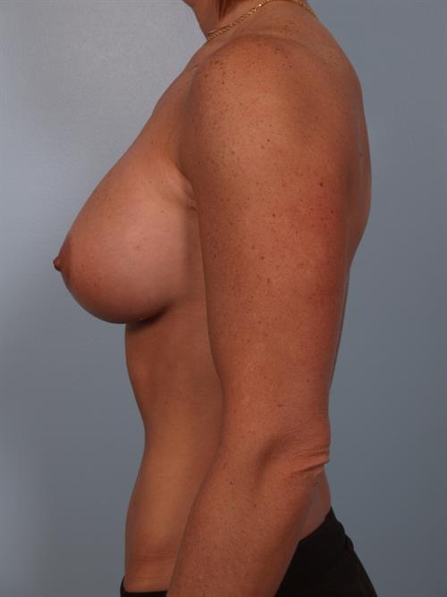 Breast Augmentation After Photo | Phoenix and Scottsdale, AZ | Scottsdale Center for Plastic Surgery