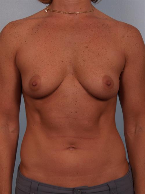 Breast Augmentation Before Photo | Phoenix and Scottsdale, AZ | Scottsdale Center for Plastic Surgery