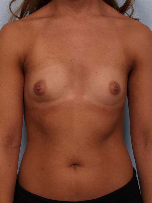 Breast Augmentation Before Photo | Phoenix and Scottsdale, AZ | Scottsdale Center for Plastic Surgery