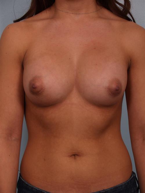 Breast Augmentation After Photo | Phoenix and Scottsdale, AZ | Scottsdale Center for Plastic Surgery