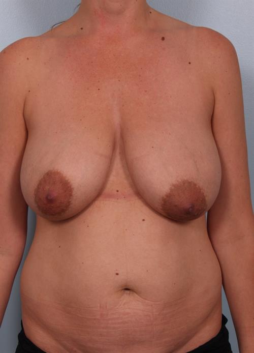 Breast Reduction Before Photo | Phoenix and Scottsdale, AZ | Scottsdale Center for Plastic Surgery