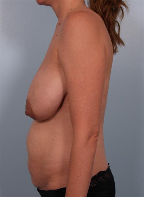 Breast Reduction Before Photo | Phoenix and Scottsdale, AZ | Scottsdale Center for Plastic Surgery