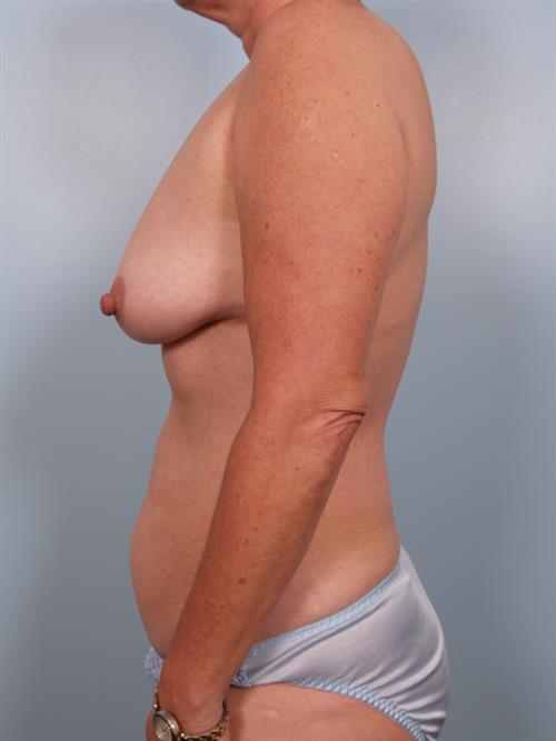 Breast Lift (Mastopexy) Before Photo | Phoenix and Scottsdale, AZ | Scottsdale Center for Plastic Surgery