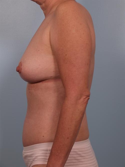Breast Lift (Mastopexy) After Photo | Phoenix and Scottsdale, AZ | Scottsdale Center for Plastic Surgery