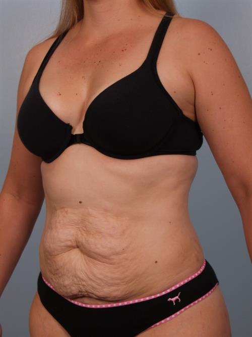 Tummy Tuck Before Photo | Phoenix and Scottsdale, AZ | Scottsdale Center for Plastic Surgery
